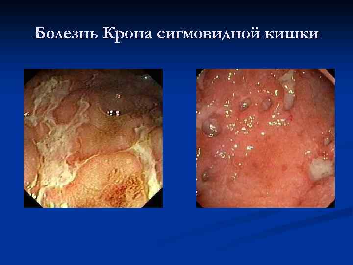 Болезнь Крона сигмовидной кишки 