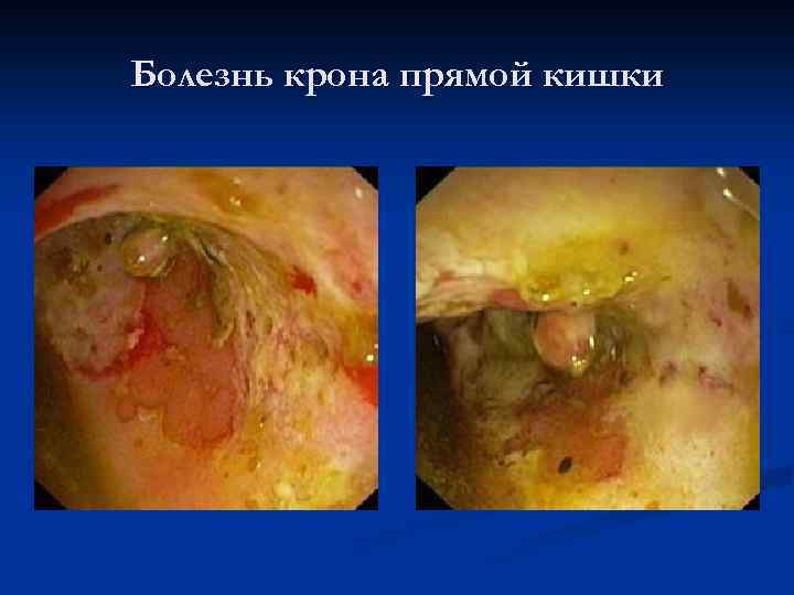 Болезнь крона прямой кишки 