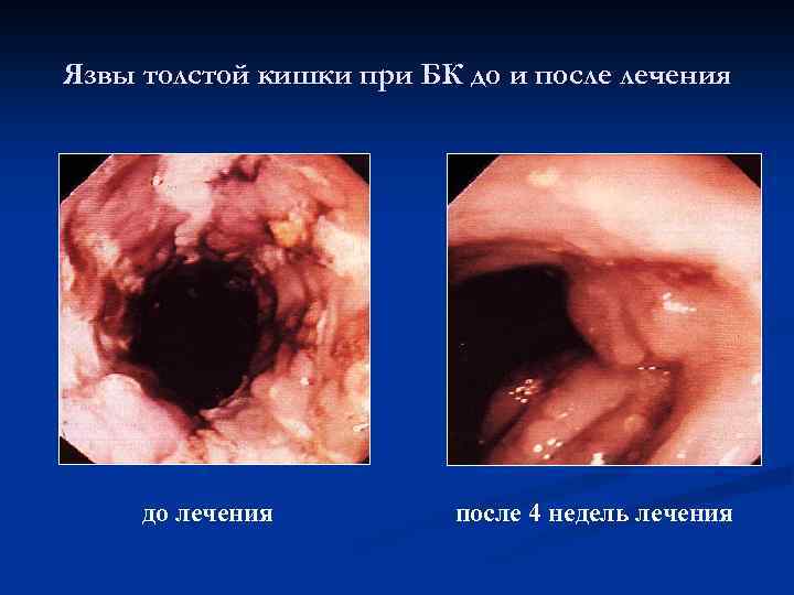 Язвы толстой кишки при БК до и после лечения до лечения после 4 недель