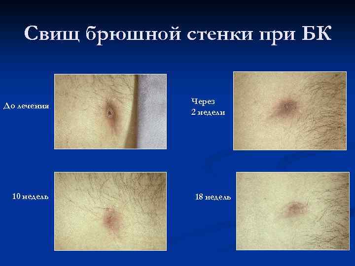 Свищ брюшной стенки при БК До лечения 10 недель Через 2 недели 18 недель