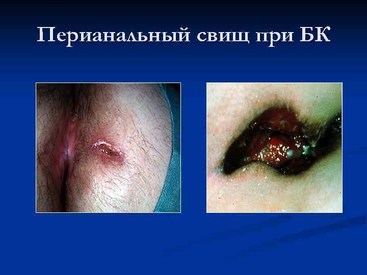 Перианальный свищ при БК 