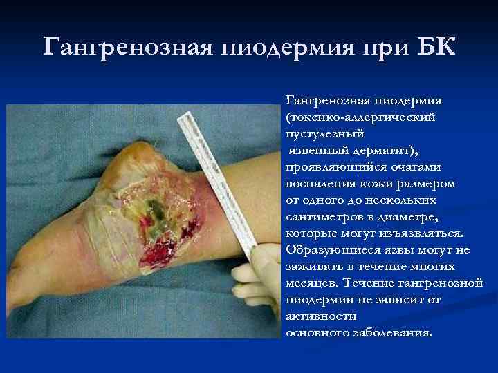 Гангренозная пиодермия при БК Гангренозная пиодермия (токсико-аллергический пустулезный язвенный дерматит), проявляющийся очагами воспаления кожи