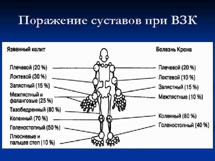 Поражение суставов при ВЗК 