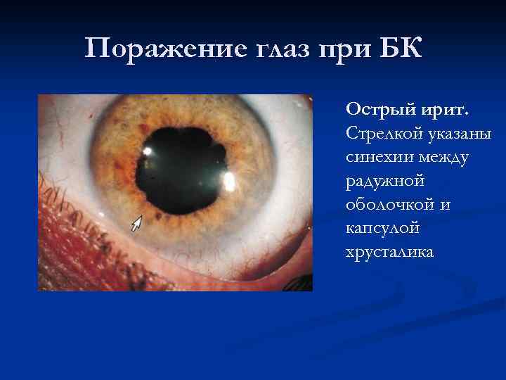 Поражение глаз при БК Острый ирит. Стрелкой указаны синехии между радужной оболочкой и капсулой