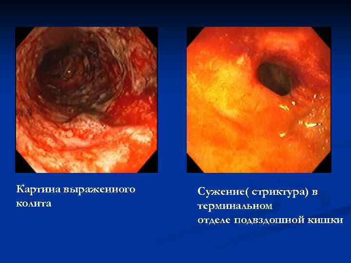 Картина выраженного колита Сужение( стриктура) в терминальном отделе подвздошной кишки 