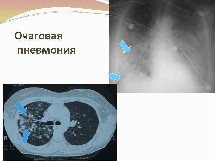 Очаговая пневмония 