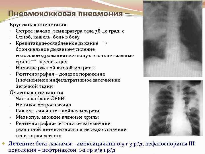 Пневмококковая пневмония – Крупозная пневмония - Острое начало, температура тела 38 -40 град. с