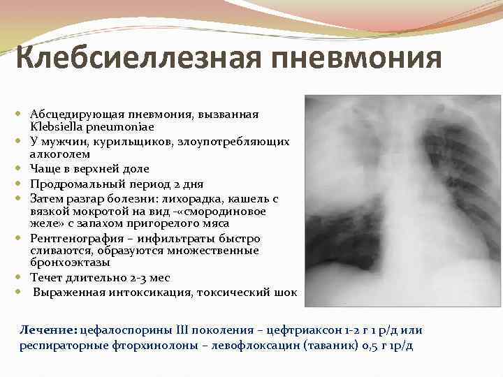 Клебсиеллезная пневмония Абсцедирующая пневмония, вызванная Klebsiella pneumoniae У мужчин, курильщиков, злоупотребляющих алкоголем Чаще в