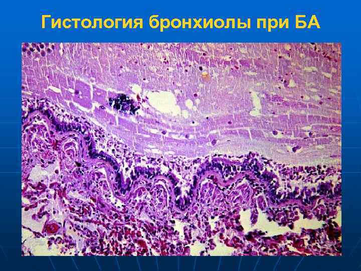 Гистология бронхиолы при БА 
