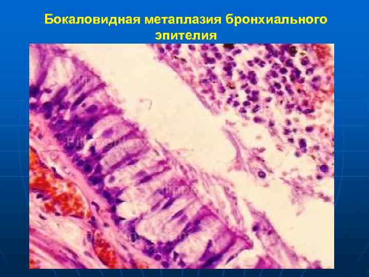Бокаловидная метаплазия бронхиального эпителия 