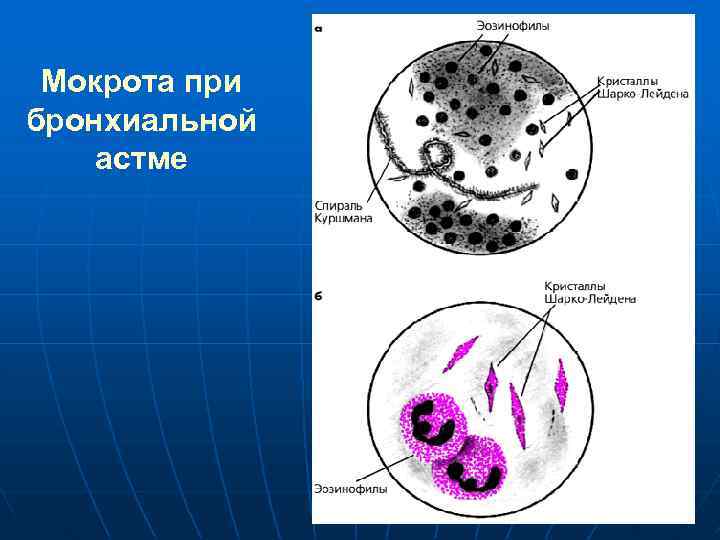 Мокрота при бронхиальной астме 