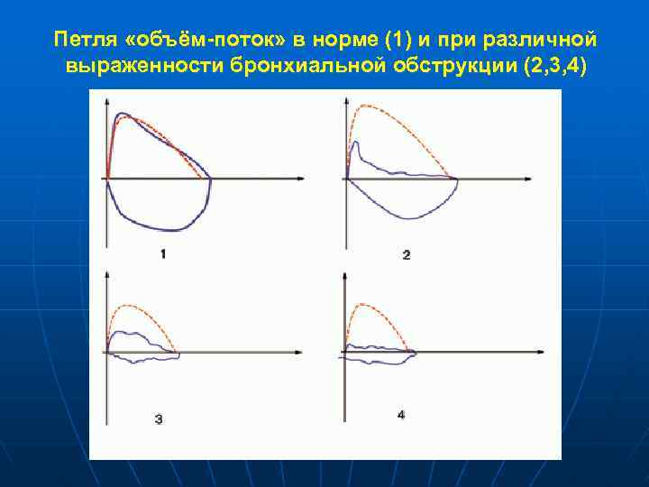 Петля «объём-поток» в норме (1) и при различной выраженности бронхиальной обструкции (2, 3, 4)