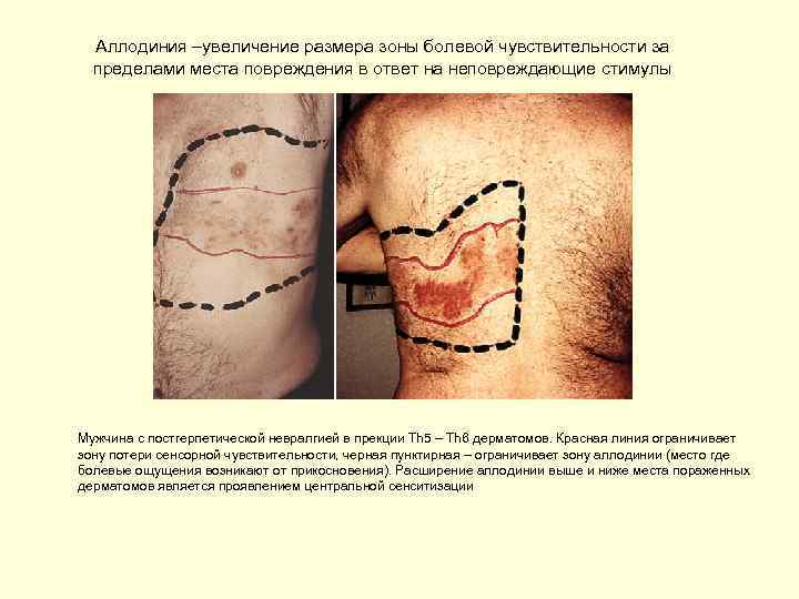 Аллодиния –увеличение размера зоны болевой чувствительности за пределами места повреждения в ответ на неповреждающие