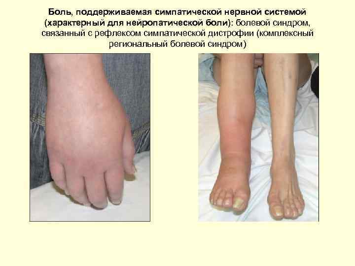 Боль, поддерживаемая симпатической нервной системой (характерный для нейропатической боли): болевой синдром, связанный с рефлексом