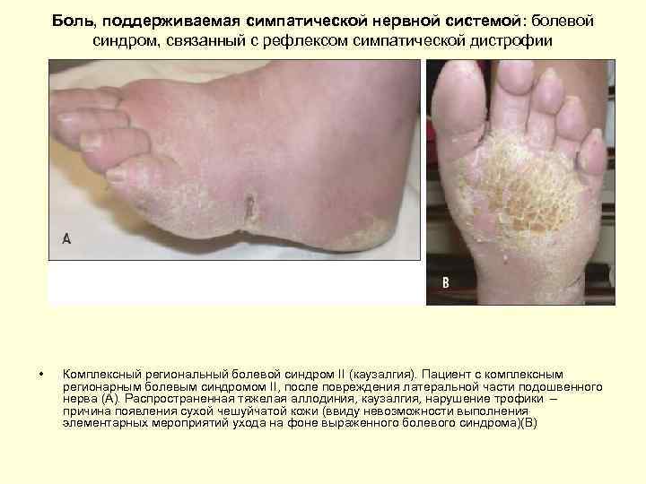 Боль, поддерживаемая симпатической нервной системой: болевой синдром, связанный с рефлексом симпатической дистрофии • Комплексный