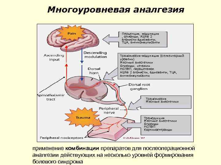 Многоуровневая аналгезия Перцепция, модуляция , опиоиды, Alpha 2 агонисты адьюванты, ТЦА, антиконвульсанты Трансмиссия-модуляция (сегментарный