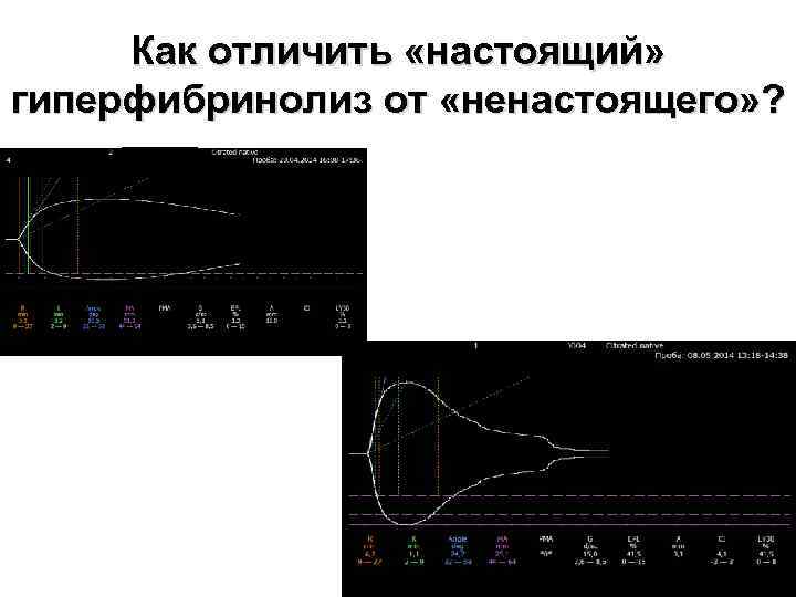 Как отличить «настоящий» гиперфибринолиз от «ненастоящего» ? 
