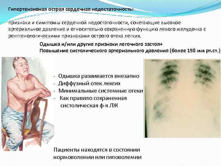 Гипертензивная острая сердечная недостаточность: признаки и симптомы сердечной недостаточности, сочетающие высокое артериальное давление и