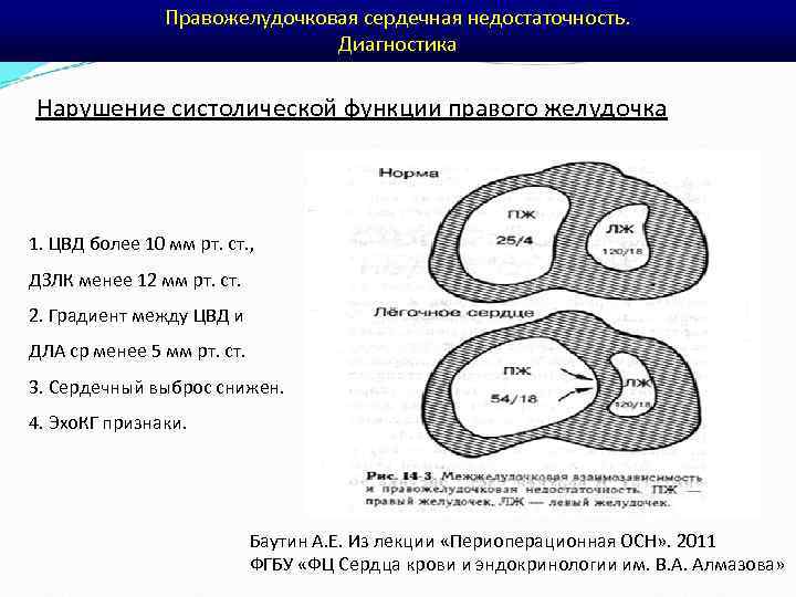 Правожелудочковая сердечная недостаточность. Диагностика Нарушение систолической функции правого желудочка 1. ЦВД более 10 мм