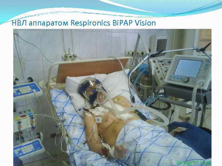 НВЛ аппаратом Respironics Bi. PAP Vision 