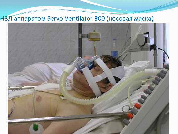 НВЛ аппаратом Servo Ventilator 300 (носовая маска) 