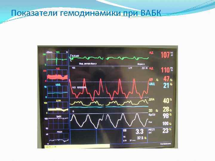 Показатели гемодинамики при ВАБК 