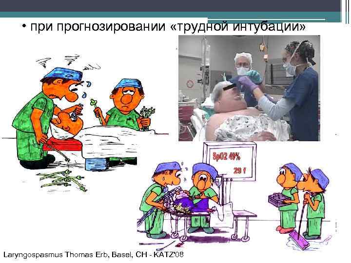  • при прогнозировании «трудной интубации» Laryngospasmus Thomas Erb, Basel, CH - KATZ'08 