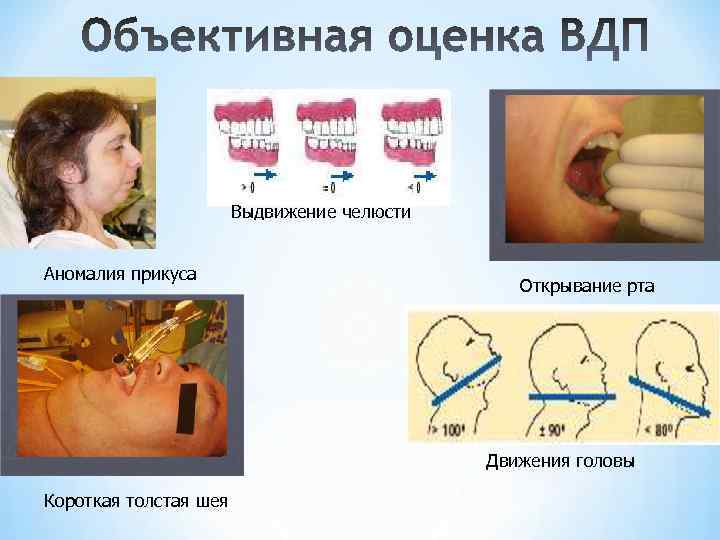 Выдвижение челюсти Аномалия прикуса Открывание рта Движения головы Короткая толстая шея 