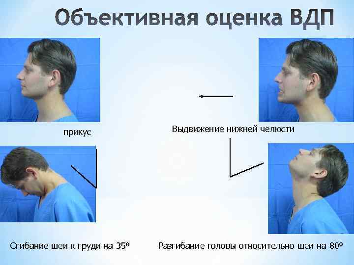 прикус Сгибание шеи к груди на 35º Выдвижение нижней челюсти Разгибание головы относительно шеи