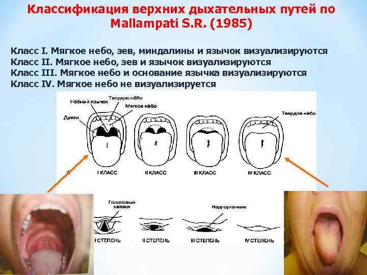 Классификация верхних дыхательных путей по Mallampati S. R. (1985) Класс I. Мягкое небо, зев,