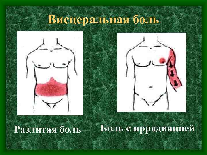 Висцеральная боль Разлитая боль Боль с иррадиацией 