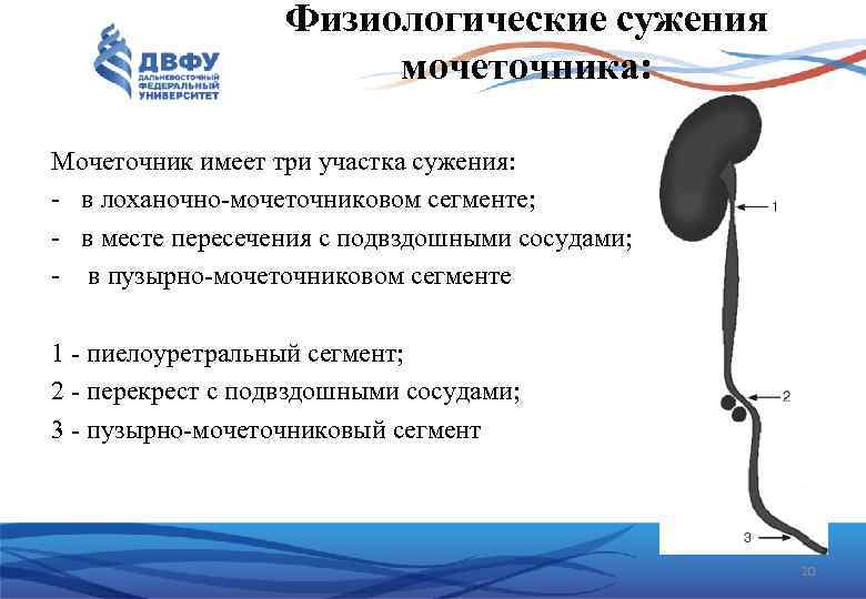 Физиологические сужения мочеточника: Мочеточник имеет три участка сужения: в лоханочно мочеточниковом сегменте; в месте