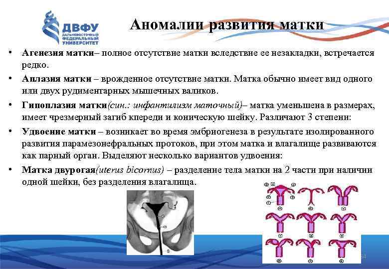 Аномалии развития матки • Агенезия матки– полное отсутствие матки вследствие ее незакладки, встречается редко.