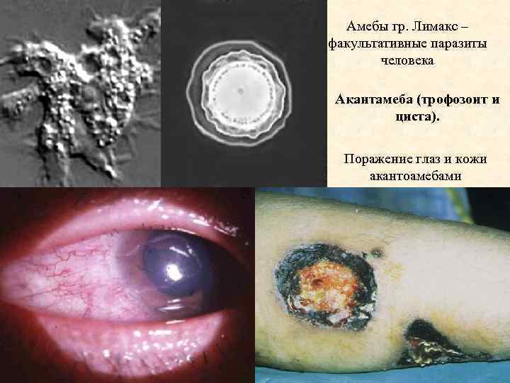 Амебы гр. Лимакс – факультативные паразиты человека Акантамеба (трофозоит и циста). Поражение глаз и