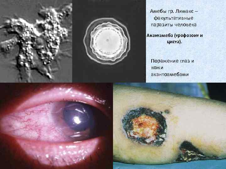 Амебы гр. Лимакс – факультативные паразиты человека Акантамеба (трофозоит и циста). Поражение глаз и