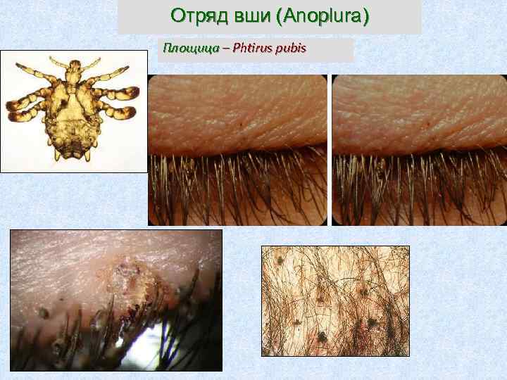 Отряд вши (Anoplura) Площица – Phtirus pubis 