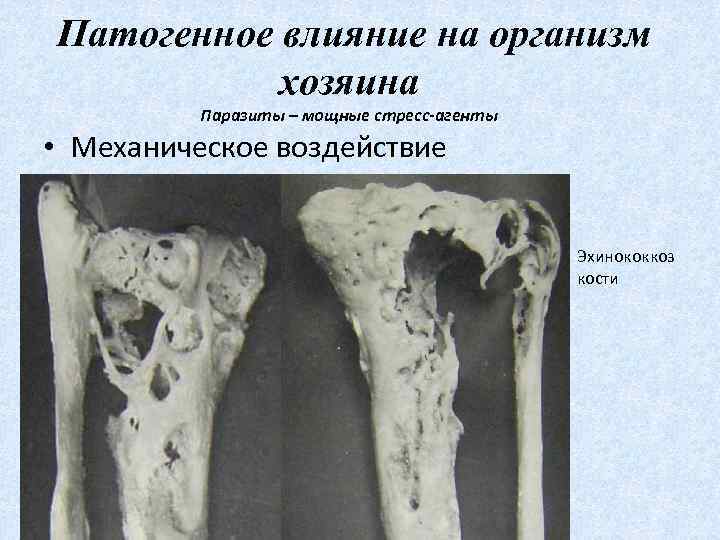 Патогенное влияние на организм хозяина Паразиты – мощные стресс-агенты • Механическое воздействие Эхинококкоз кости