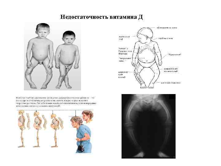 Недостаточность витамина Д 
