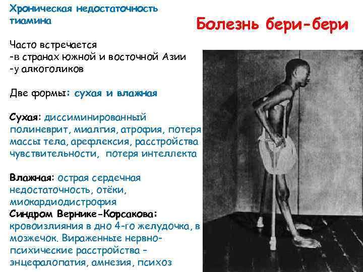 Хроническая недостаточность тиамина Болезнь бери-бери Часто встречается -в странах южной и восточной Азии -у