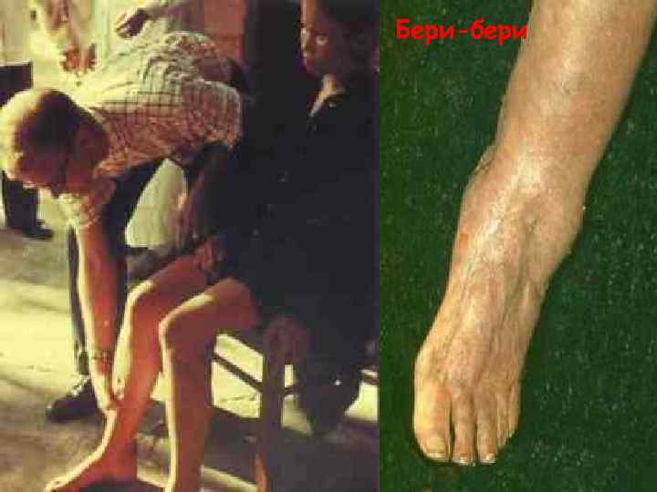Бери-бери 