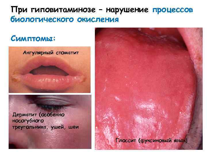При гиповитаминозе – нарушение процессов биологического окисления Симптомы: Ангулярный стоматит Дерматит (особенно носогубного треугольника,