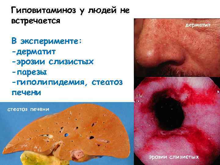 Гиповитаминоз у людей не встречается дерматит В эксперименте: -дерматит -эрозии слизистых -парезы -гиполипидемия, стеатоз