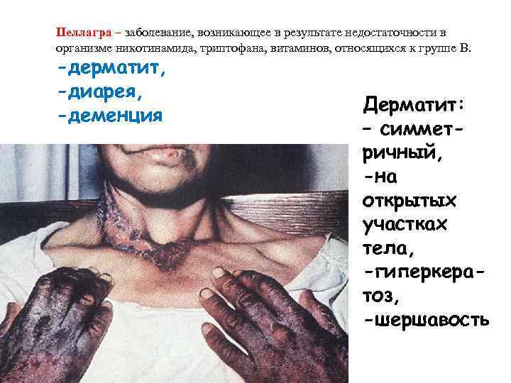 Пеллагра – заболевание, возникающее в результате недостаточности в организме никотинамида, триптофана, витаминов, относящихся к