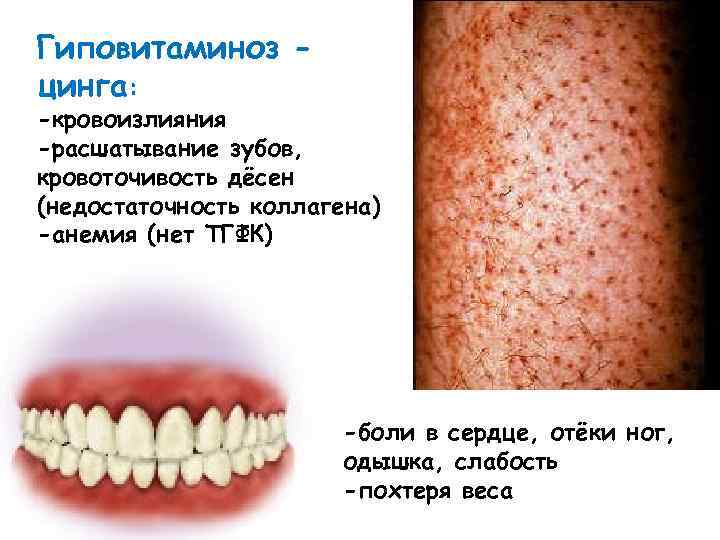 Гиповитаминоз цинга: -кровоизлияния -расшатывание зубов, кровоточивость дёсен (недостаточность коллагена) -анемия (нет ТГФК) -боли в