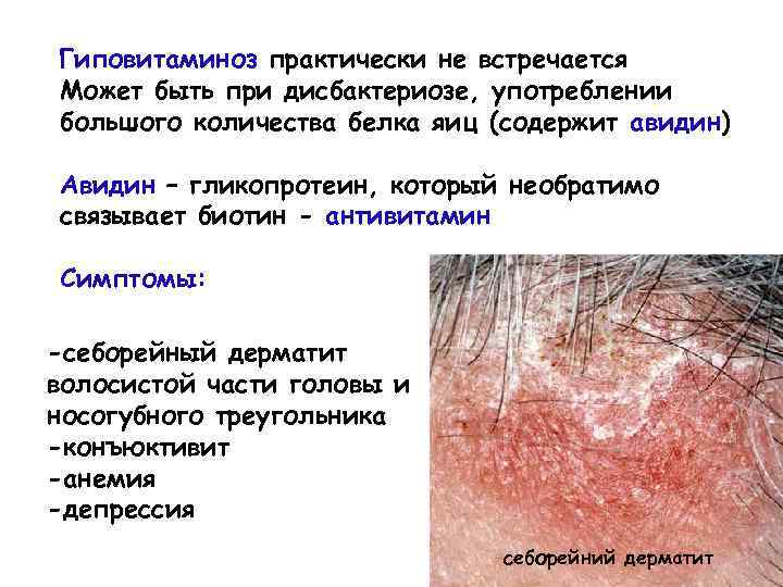 Гиповитаминоз практически не встречается Может быть при дисбактериозе, употреблении большого количества белка яиц (содержит