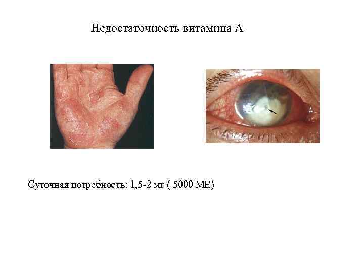 Недостаточность витамина А Суточная потребность: 1, 5 -2 мг ( 5000 МЕ) 