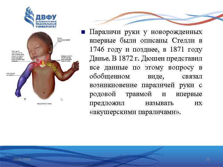  16. 02. 2018 Параличи руки у новорожденных впервые были описаны Стелли в 1746