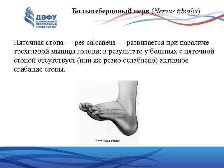 Большеберцовый нерв (Nervus tibialis) Пяточная стопа — pes calcaneus — развивается при параличе трехглавой