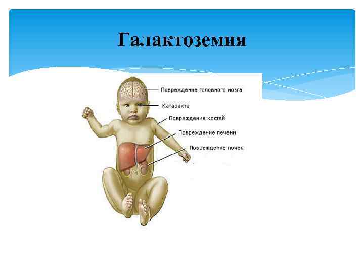 Галактоземия 