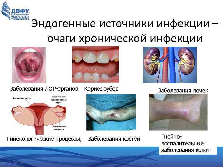 Эндогенные источники инфекции – очаги хронической инфекции Заболевания ЛОР-органов Кариес зубов Гинекологические процессы, Заболевания